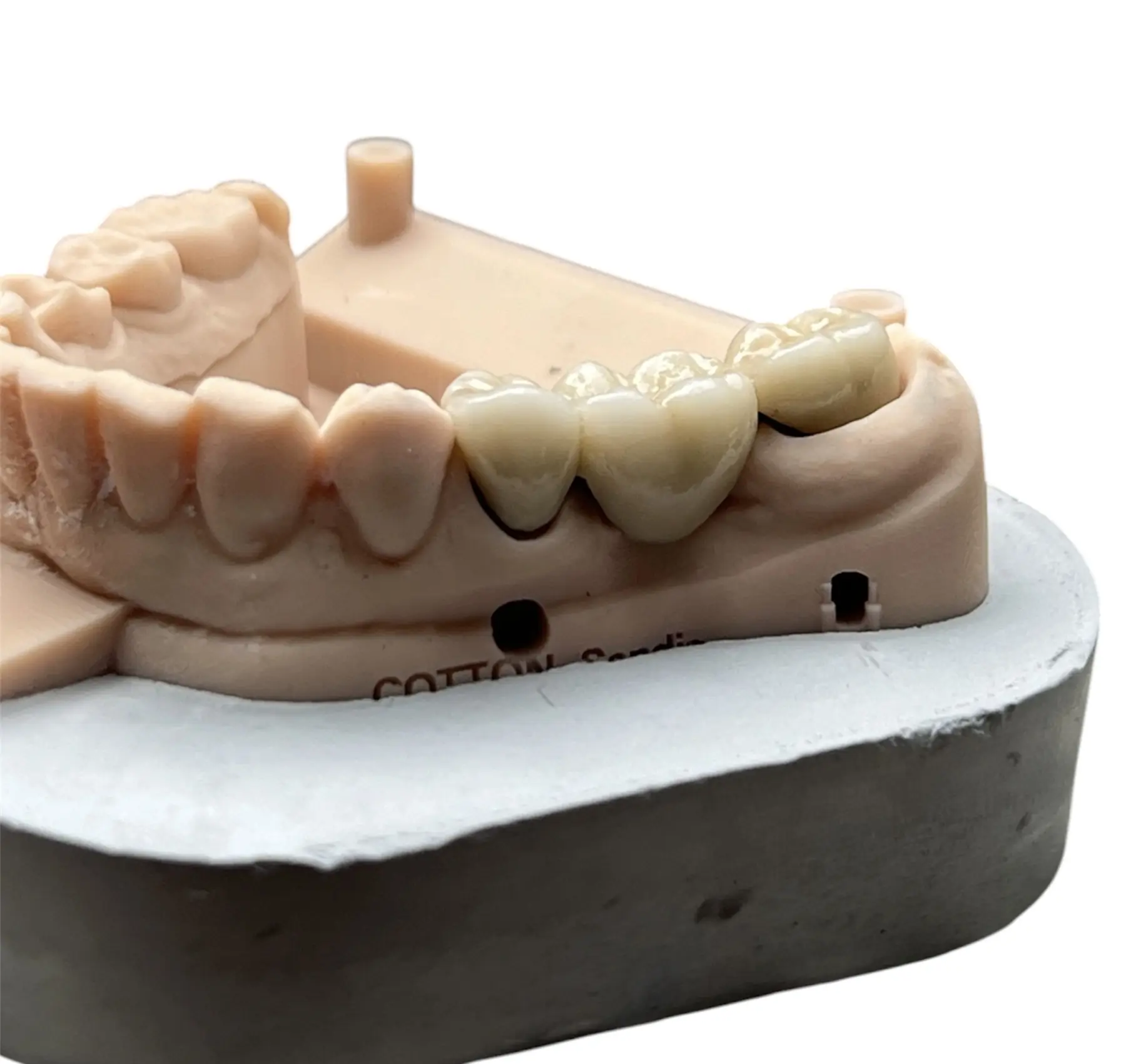 Cas de prothèse réalisée sur modèle 3D