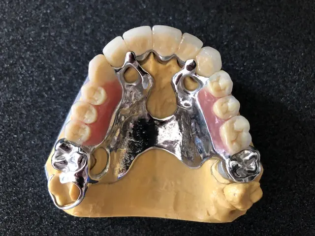 Prothèse partielle à châssis métallique chrome-cobalt sur modèle