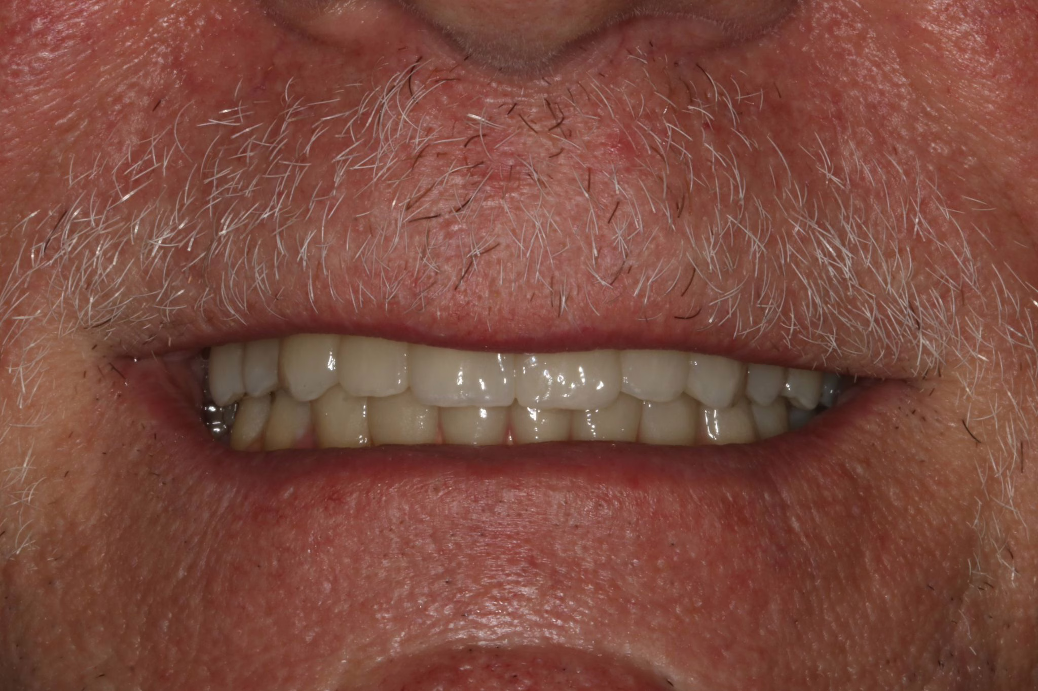 Bridge complet sur barre Timblecrown BioHPP bredent avec unitaires zircones — sourire du patient.
