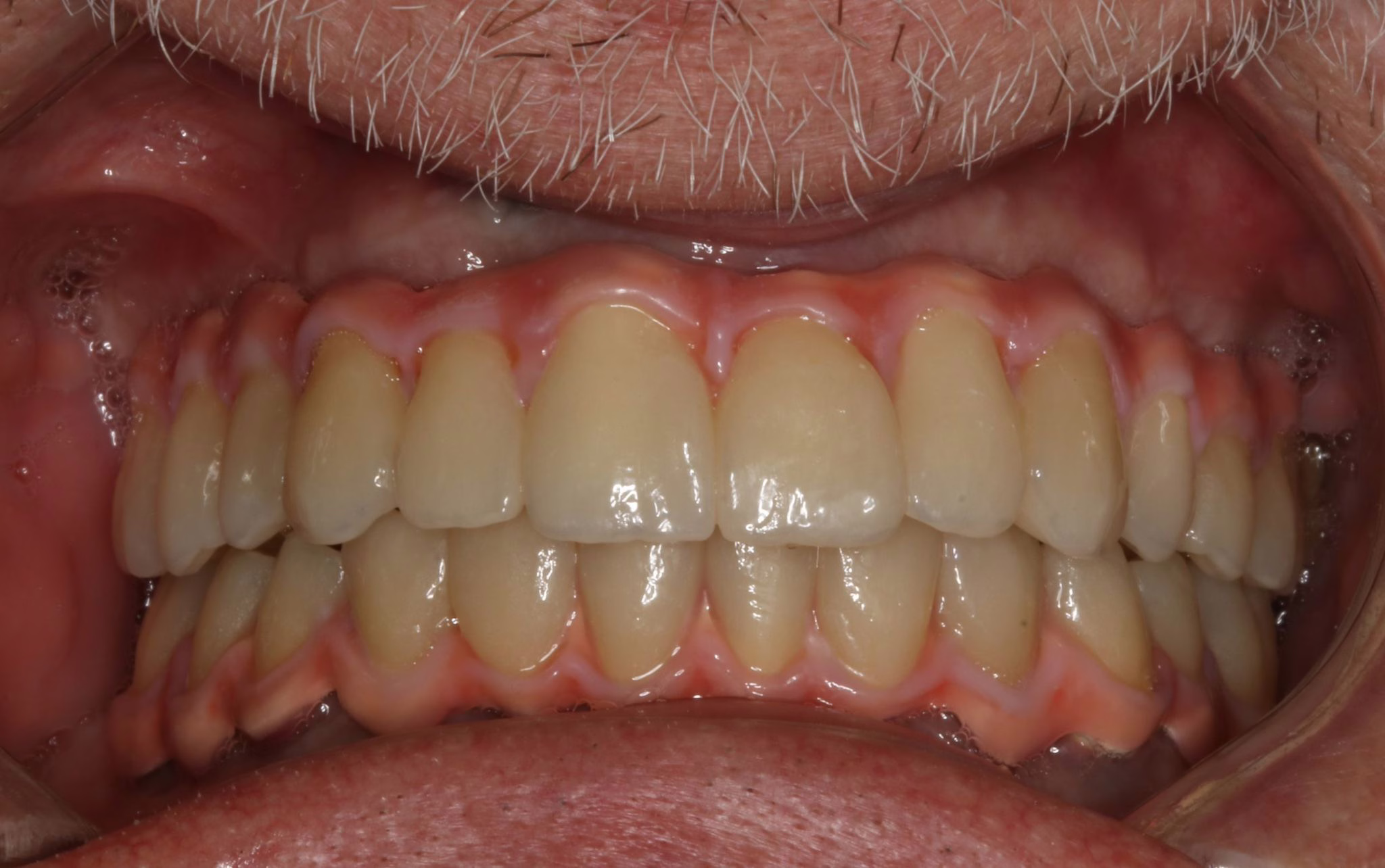 Bridge complet sur barre Timblecrown BioHPP avec unitaires zircones — vue frontale de la prothèse.