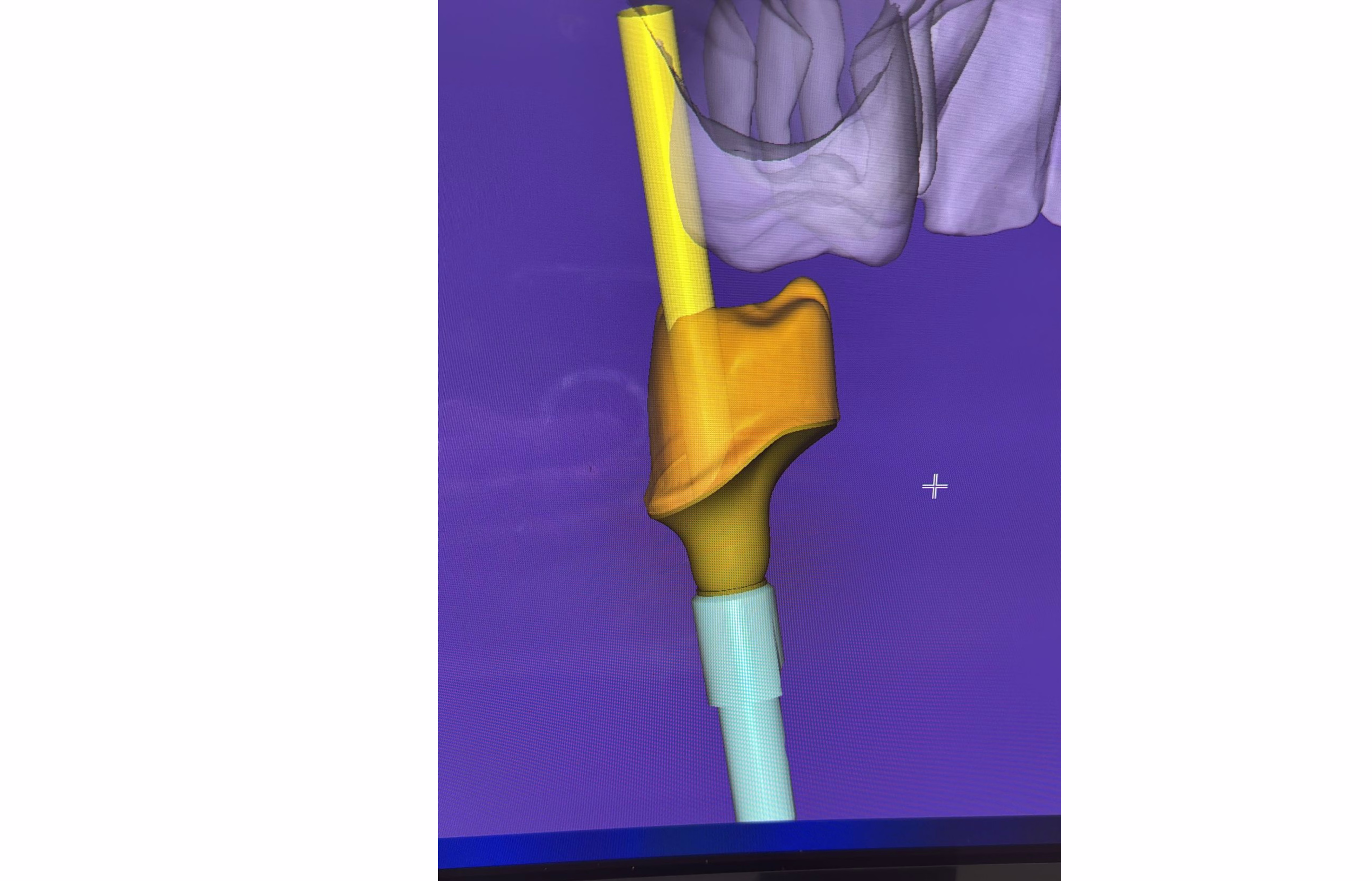 Conception CFAO du pilier implantaire personnalisé : modèle 3D et profil d'émergence sur planification numérique.