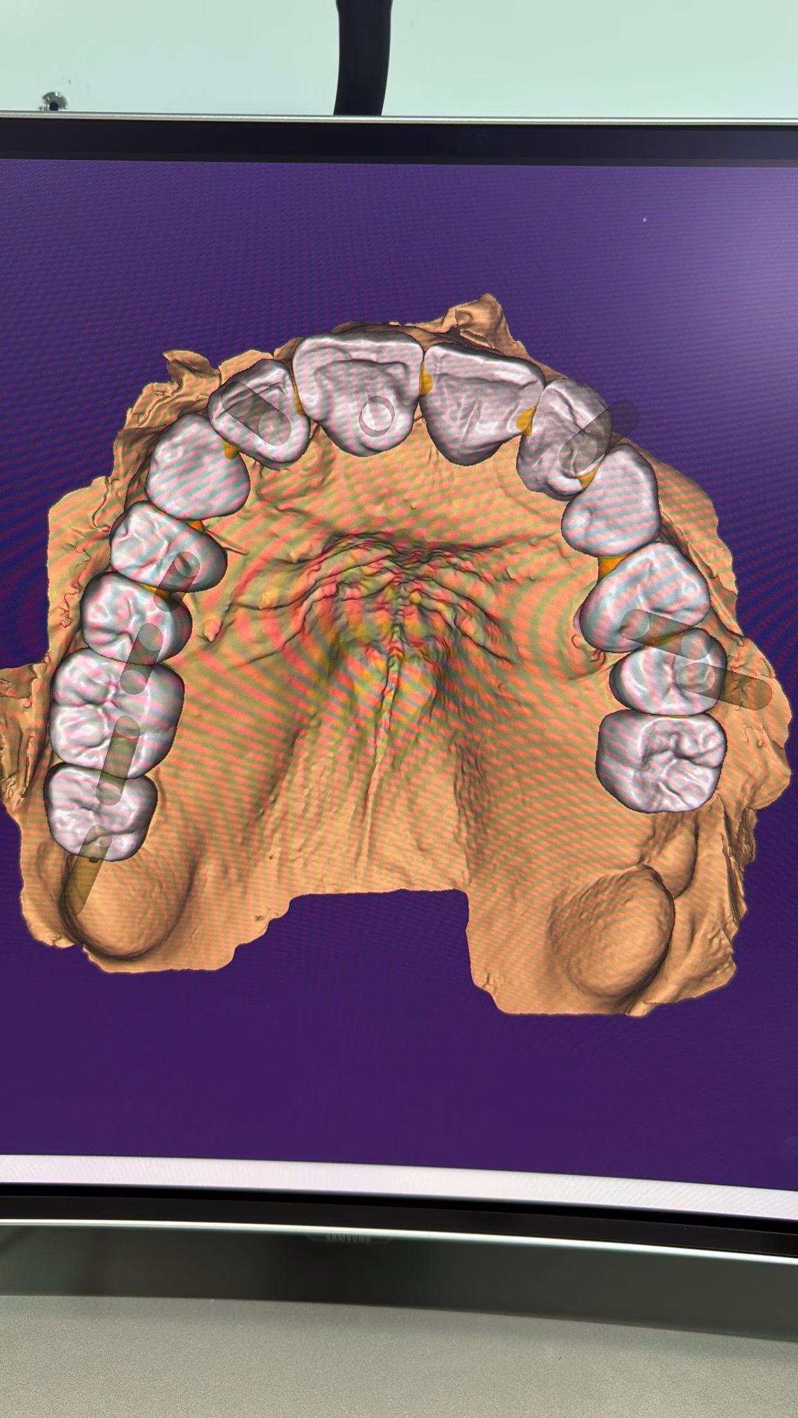 Usinage en PMMA multi-couche suite implantation : prothèse provisoire usinée au laboratoire, vue 1.
