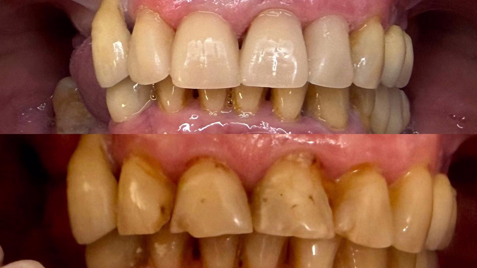 Cas clinique 1 — réhabilitation antérieure après wax-up et prothèses conjointes.