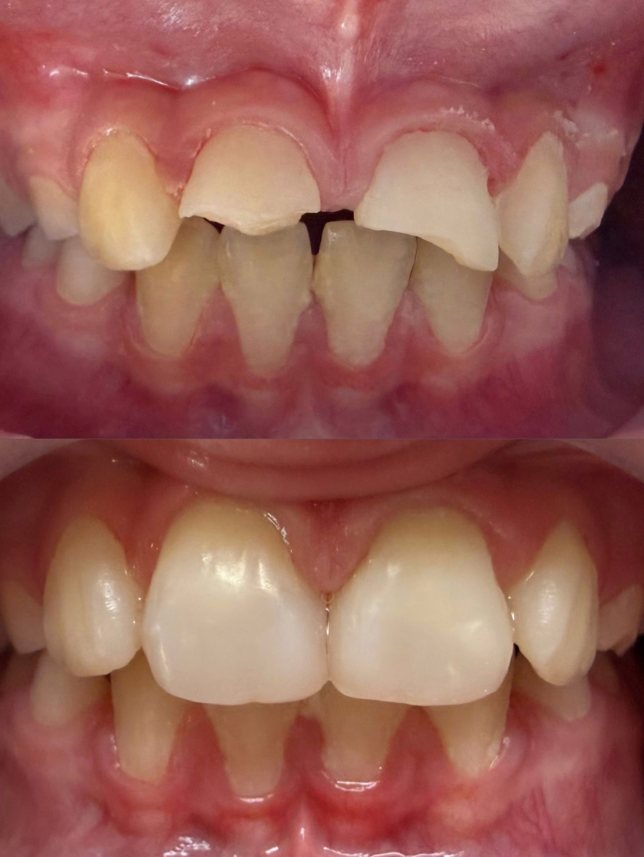 Cas clinique 2 — reconstruction antérieure après wax-up et restaurations conjointes.