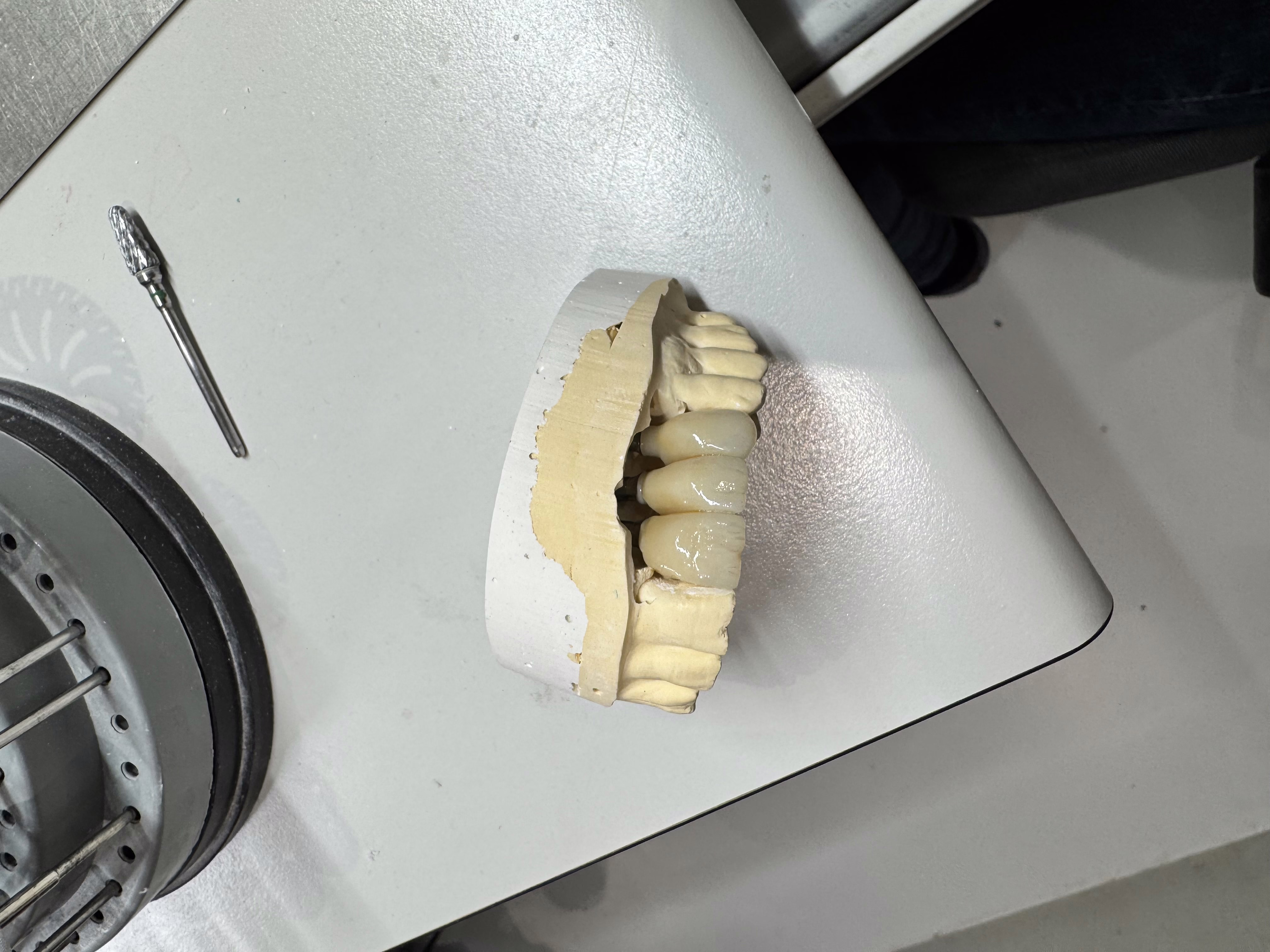 Bridge sur Implant avec Extension 1