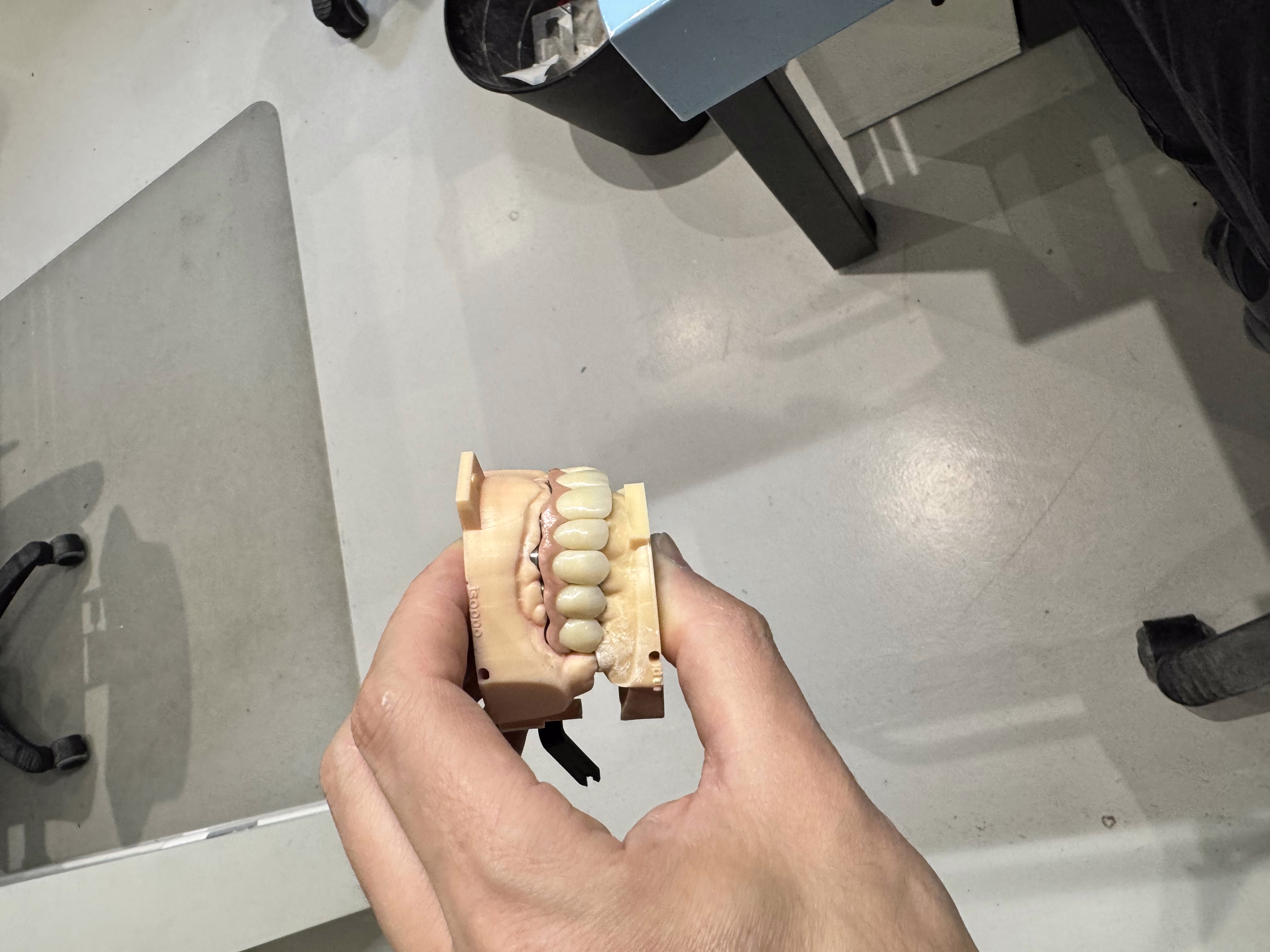 Bridge sur Implant avec Extension 3