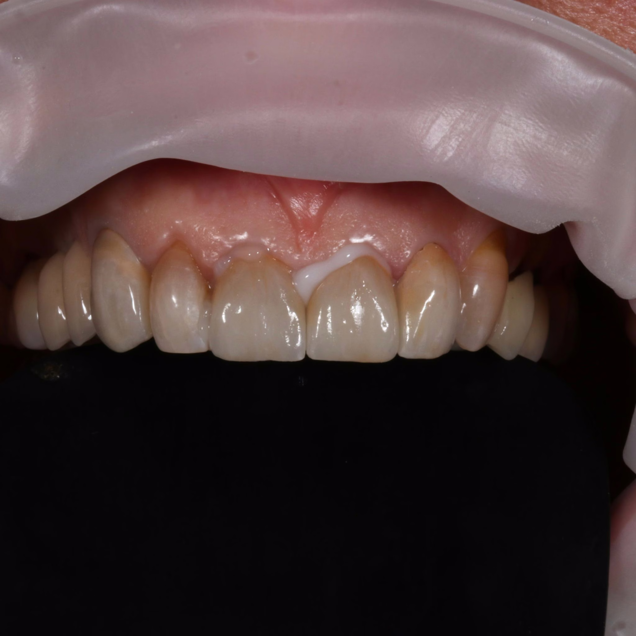 Cas clinique — prothèse conjointe 2