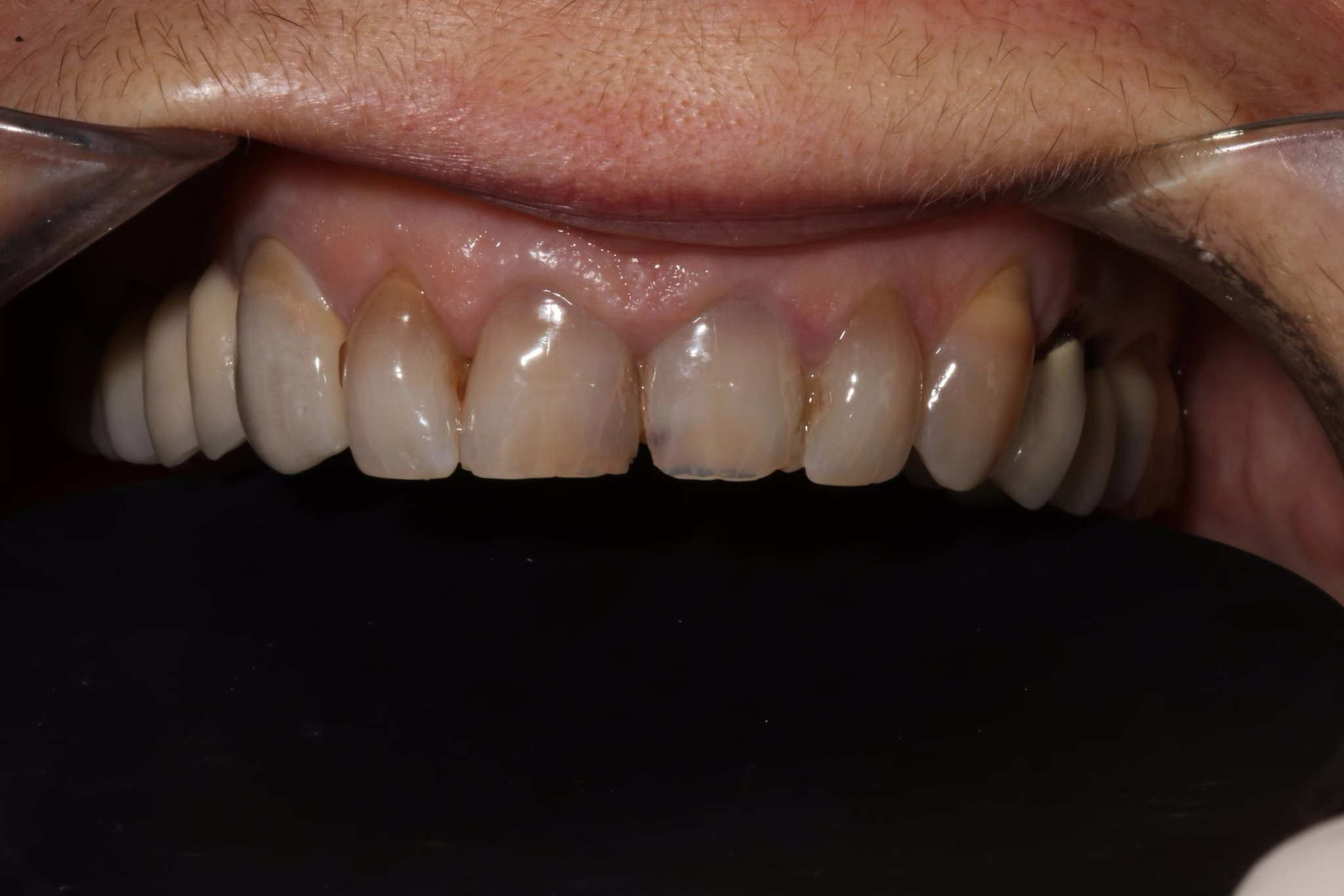Cas clinique — prothèse conjointe 3