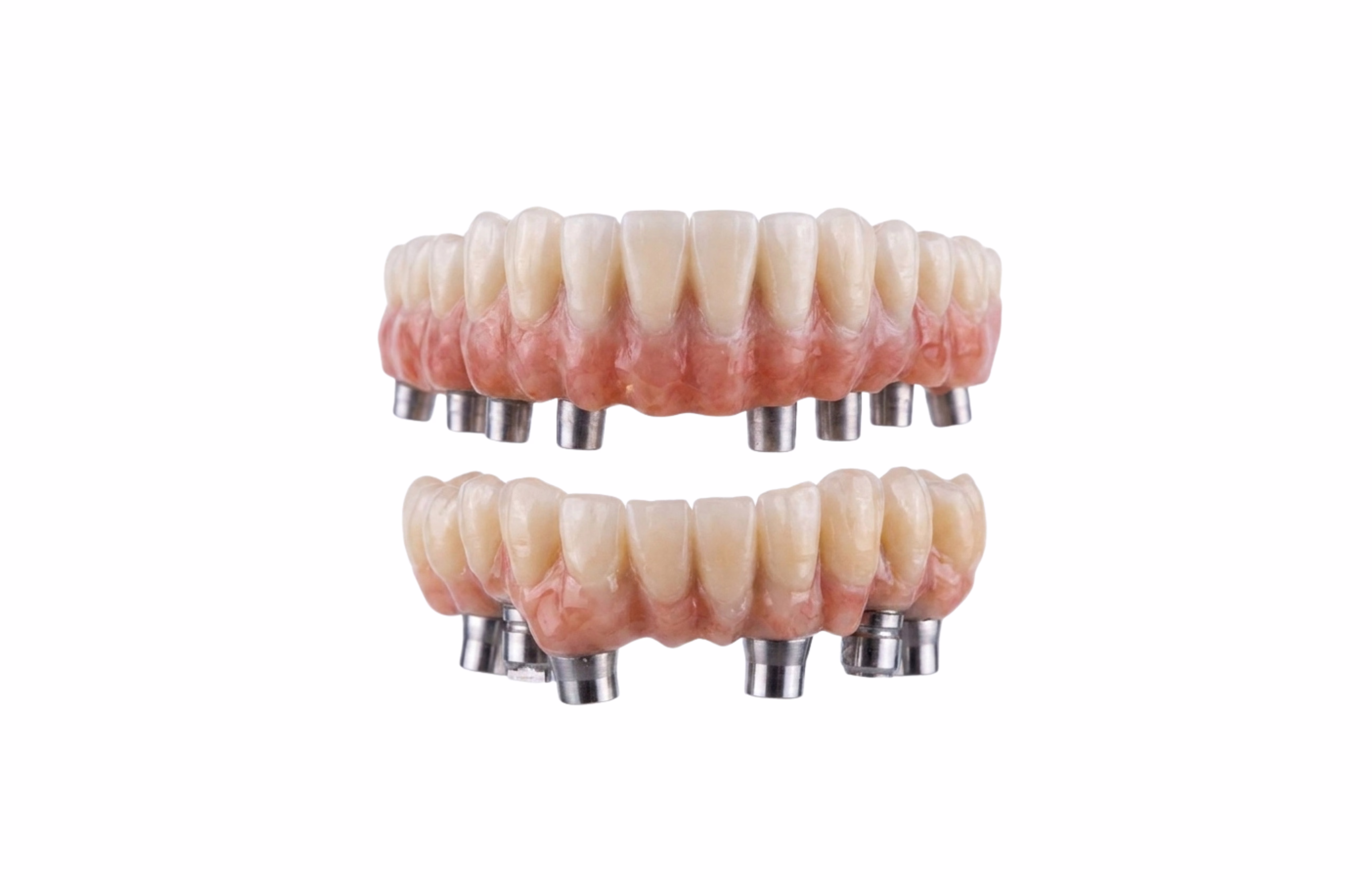 Cas implantaire — laboratoire 2J Dentaires
