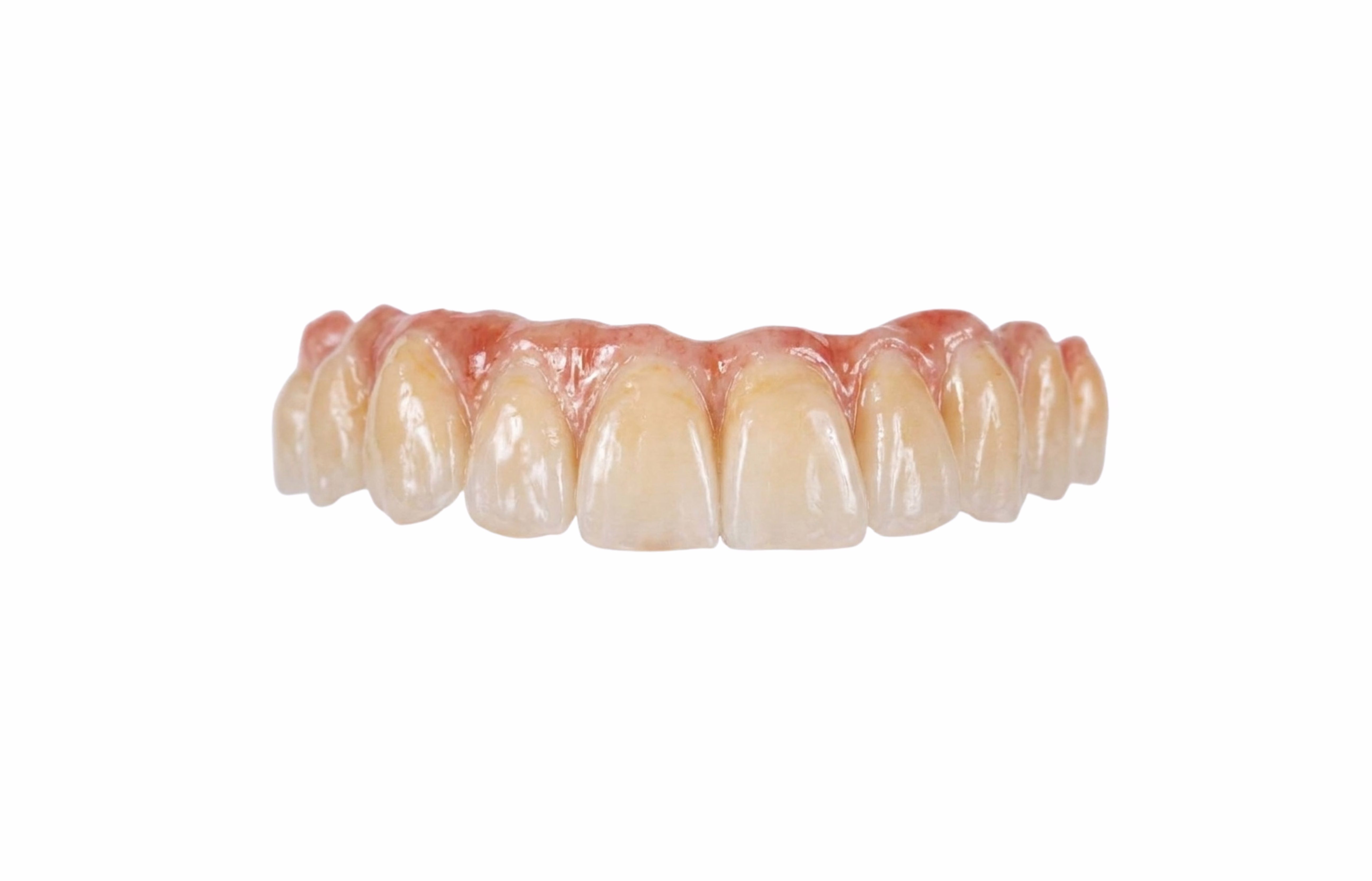 Prothèse sur implant — détail technique